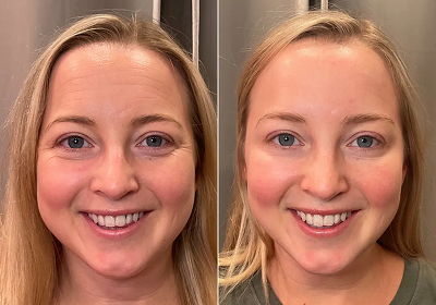 botox